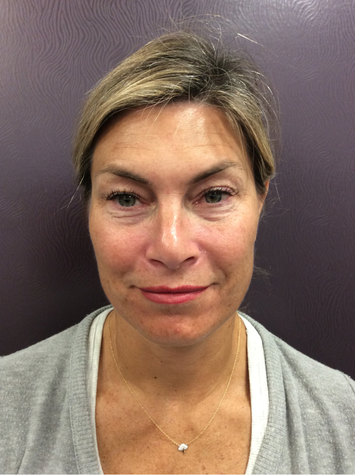 Medical Grade Skin Care Before Patient 3