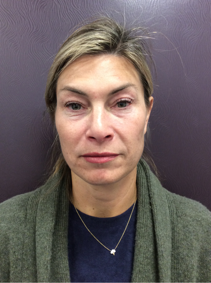 Medical Grade Skin Care After Patient 3