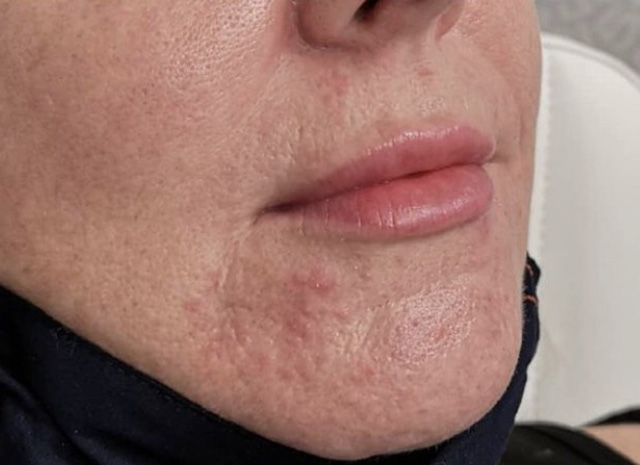 Lip Filler After Patient 16
