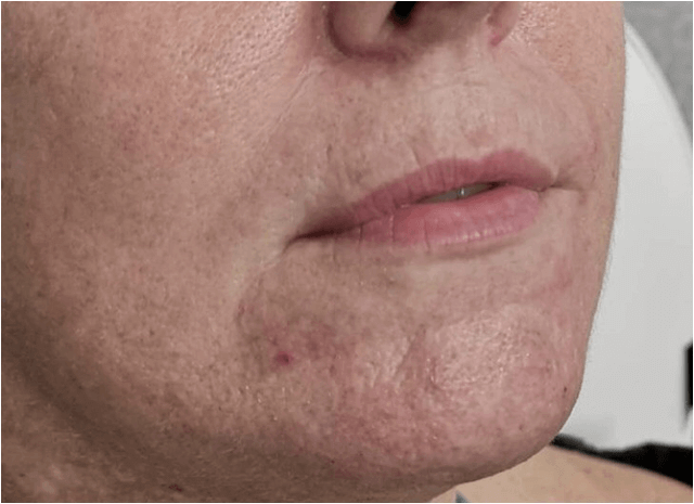 Lip Filler Before Patient 16