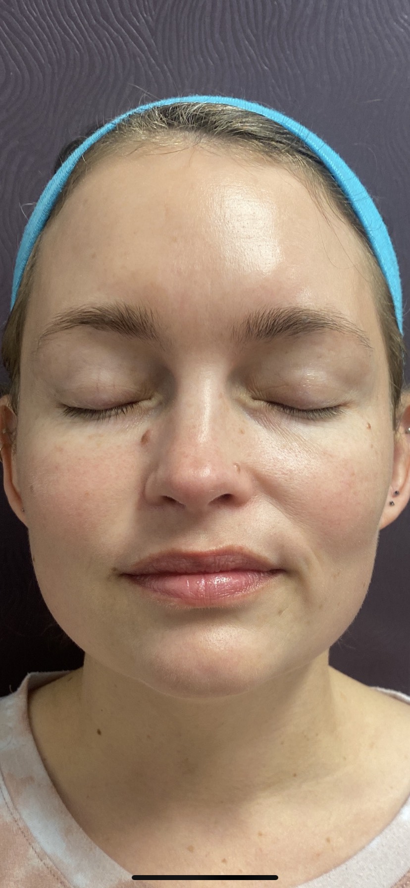 Vein Gogh After Patient 4