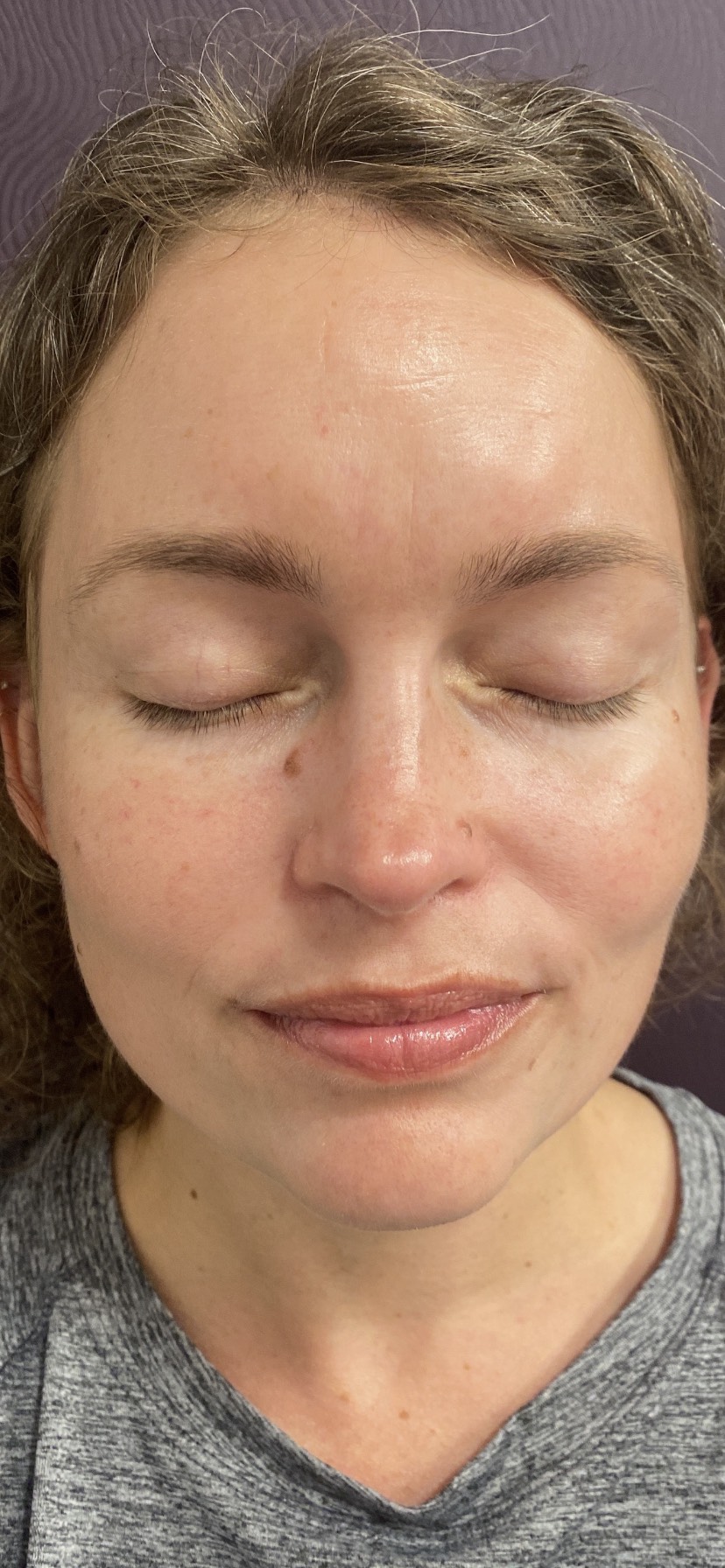 Vein Gogh Before Patient 4