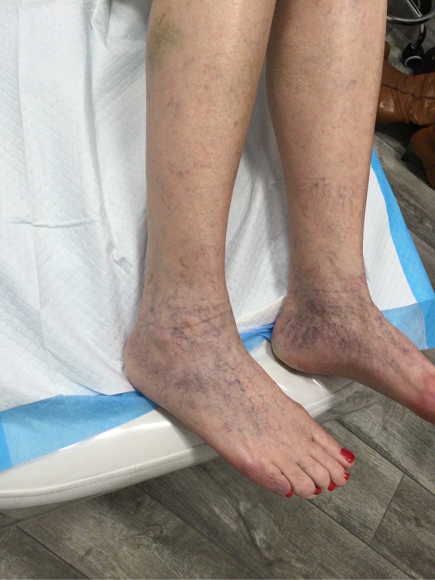Sclerotherapy Before Patient 1