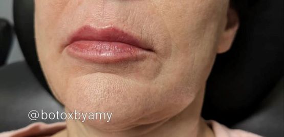 Lip Filler After Patient 13