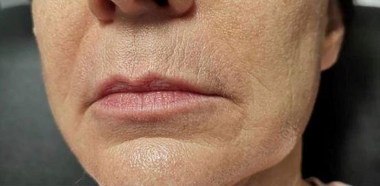 Lip Filler Before Patient 13