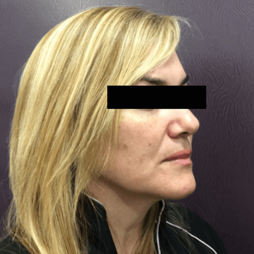 IPL Laser for Sun Damage Spots Patient 01 Mountcastle Medical Spa and Laser Center