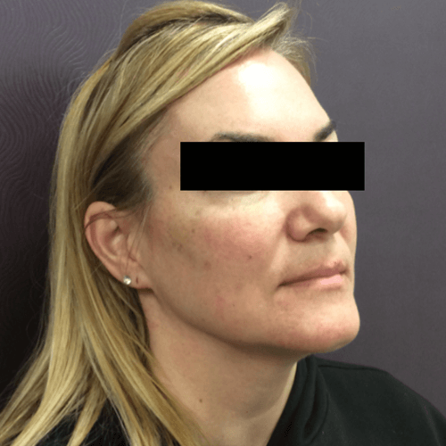IPL Laser for Sun Damage Spots Patient 01 Mountcastle Medical Spa and Laser Center