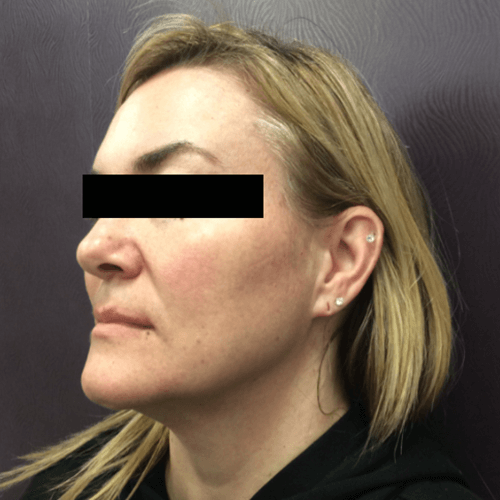 IPL Laser for Sun Damage Spots Patient 01 Mountcastle Medical Spa and Laser Center