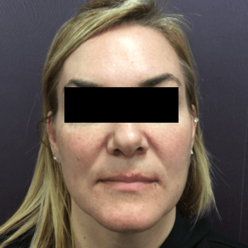 IPL Photo Rejuvenation After Patient 2
