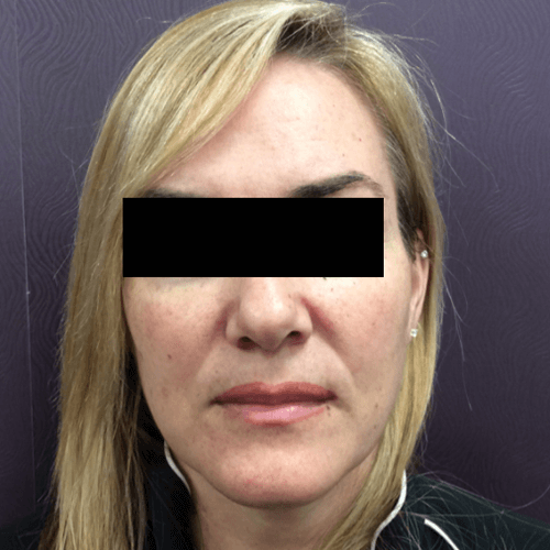 IPL Photo Rejuvenation Before Patient 2