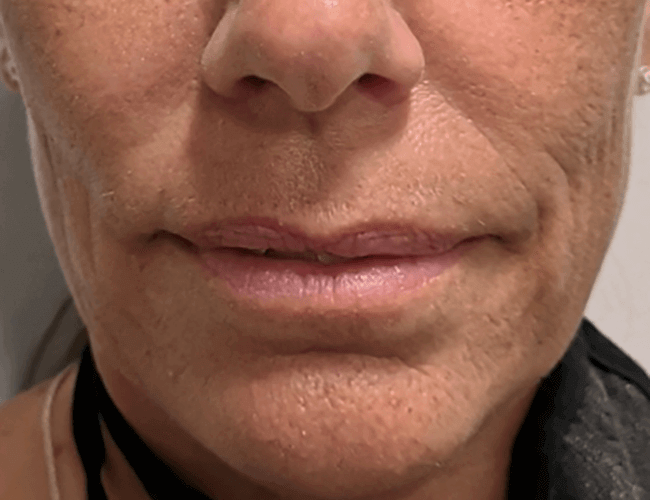 Microneedling After Patient 1