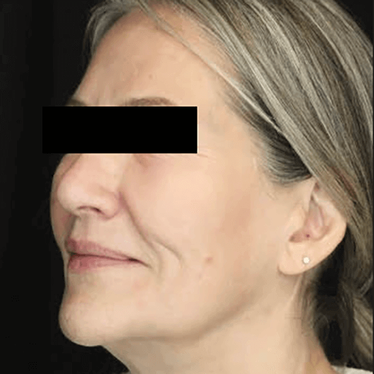 Medical Grade Skin Care After Patient 2
