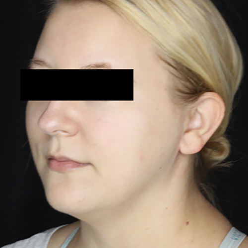 Medical Spa After Patient 5