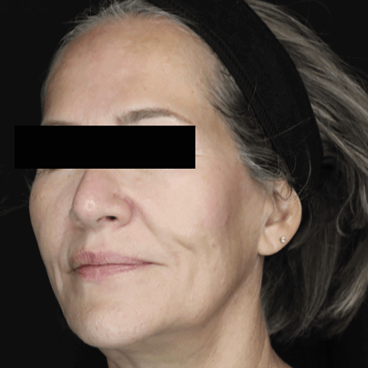 Medical Grade Skin Care Before Patient 2