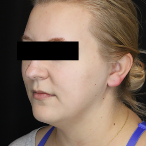 Medical Spa Before Patient 5