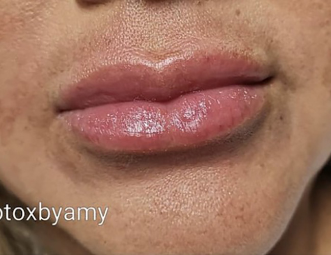 Lip Filler After Patient 24