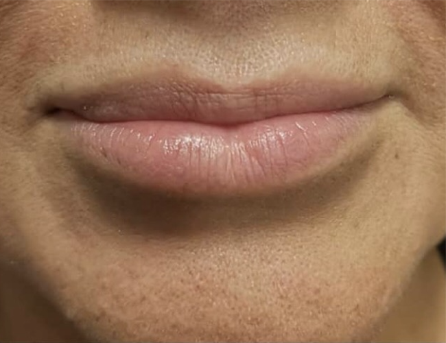 Lip Filler Before Patient 24