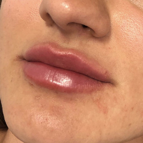 Lip Filler After Patient 22