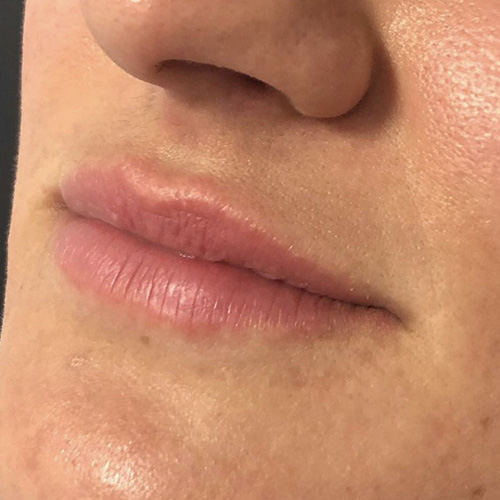 Lip Filler Before Patient 22