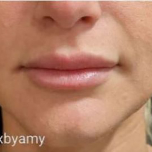 Lip Filler After Patient 26