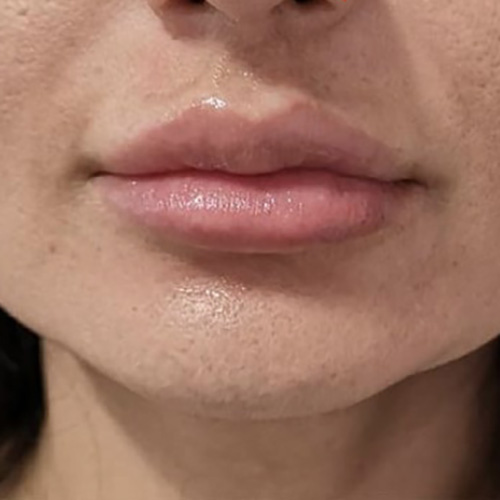 Lip Filler After Patient 28