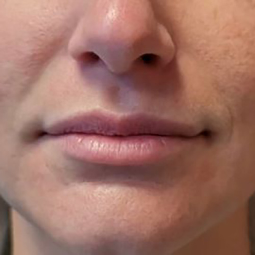 Lip Filler Before Patient 26