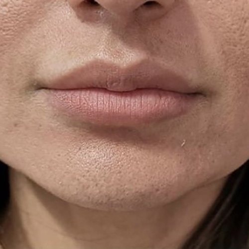 Lip Filler Before Patient 28