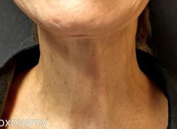 Botox and Dysport After Patient 21