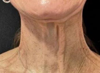 Botox and Dysport Before Patient 21