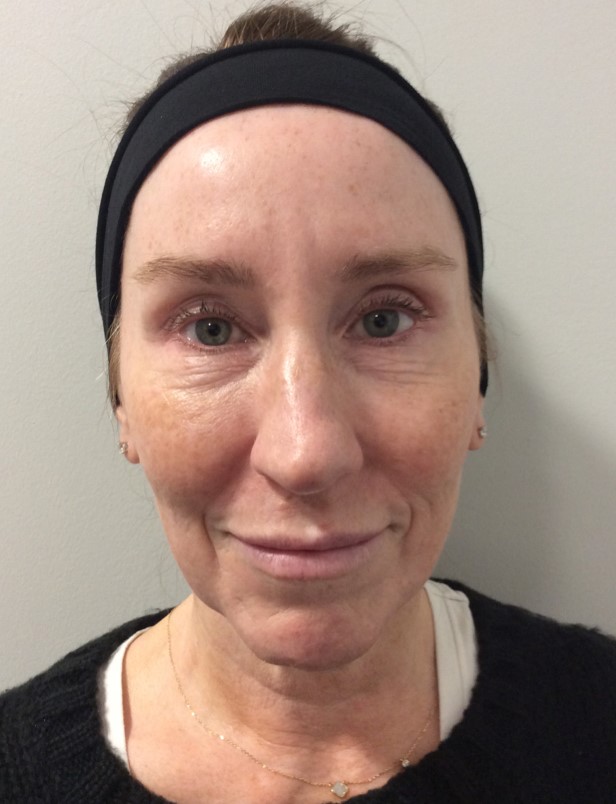 Medical Spa Before Patient 1