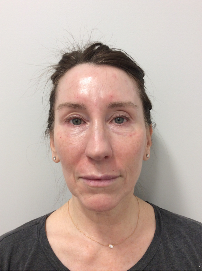 Medical Spa After Patient 1