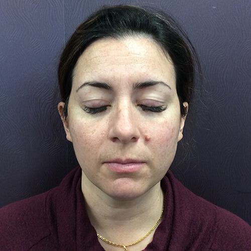 IPL Photo Rejuvenation Before Patient 3