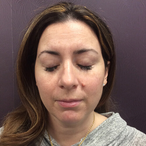 IPL Photo Rejuvenation After Patient 3